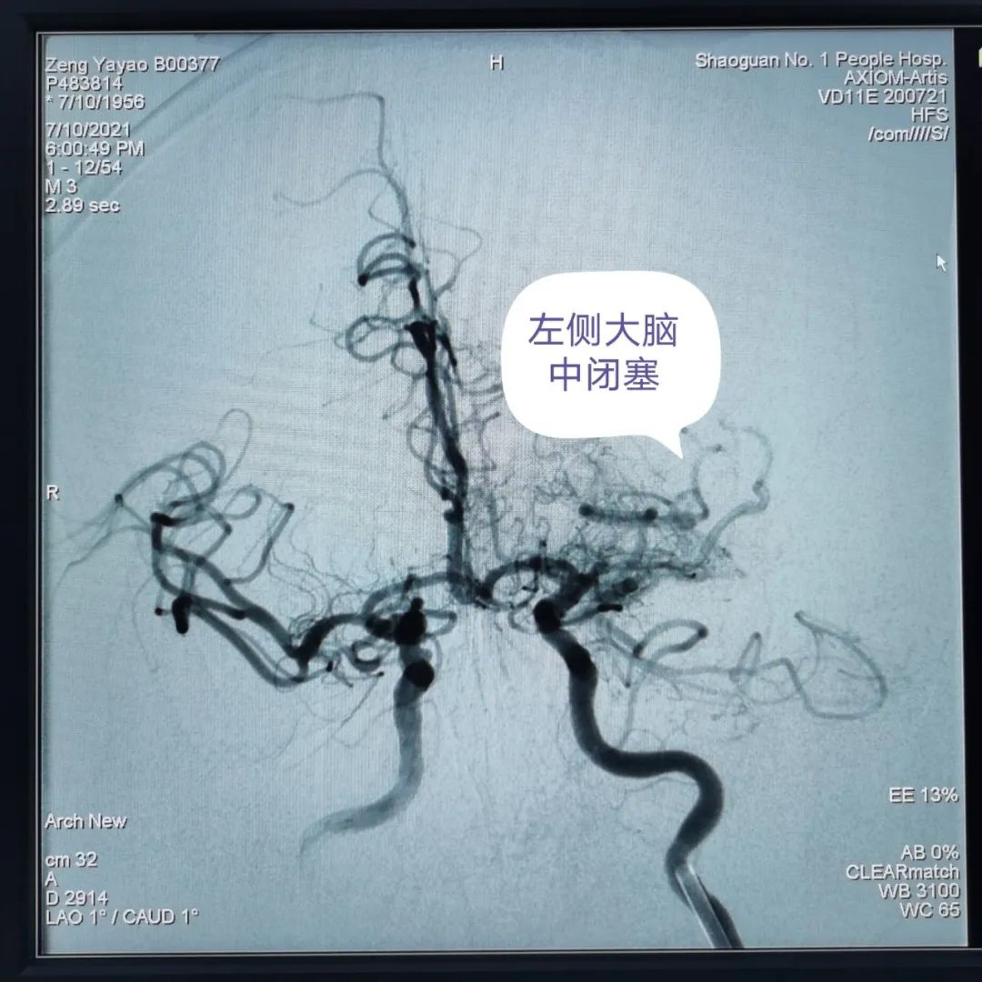 【高水平醫(yī)院建設(shè)】介入取栓顯奇效 腦梗死患者術(shù)后迅速恢復(fù)(圖4) 圖片