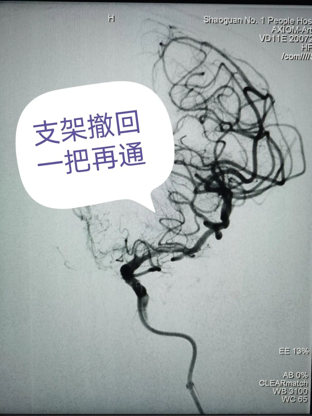 【高水平醫(yī)院建設(shè)】介入取栓顯奇效 腦梗死患者術(shù)后迅速恢復(fù)(圖5) 圖片