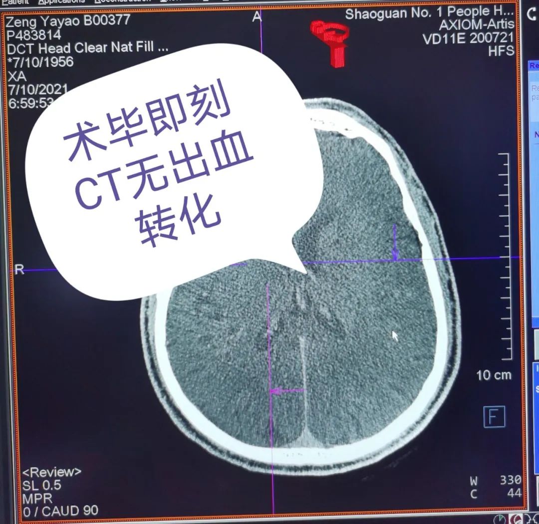 【高水平醫(yī)院建設(shè)】介入取栓顯奇效 腦梗死患者術(shù)后迅速恢復(fù)(圖7) 圖片